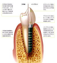 天然歯に近いインプラント